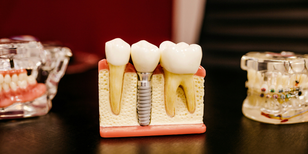Dental Implants and Dentures